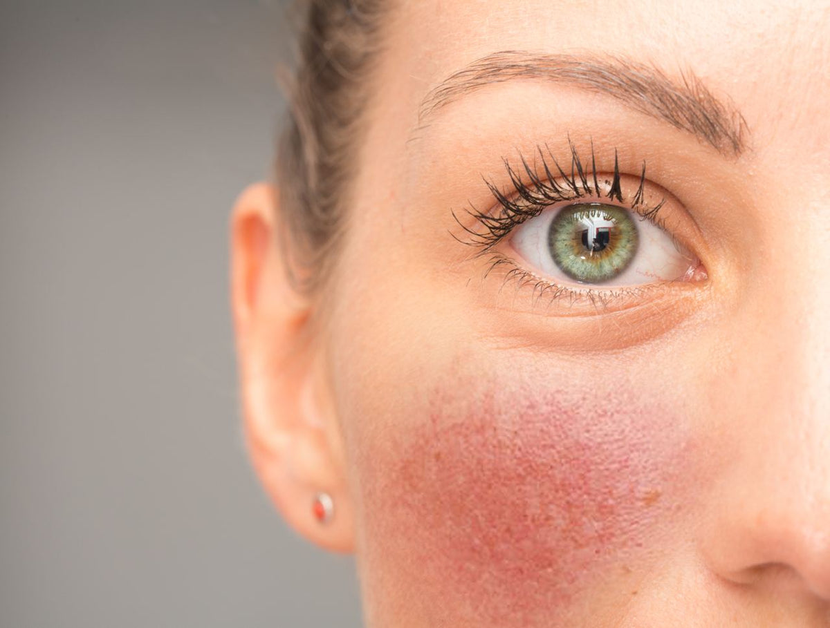 Rosacea del viso